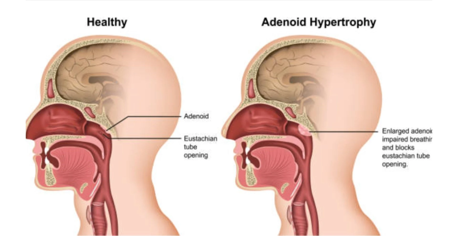 Adenoidectomy