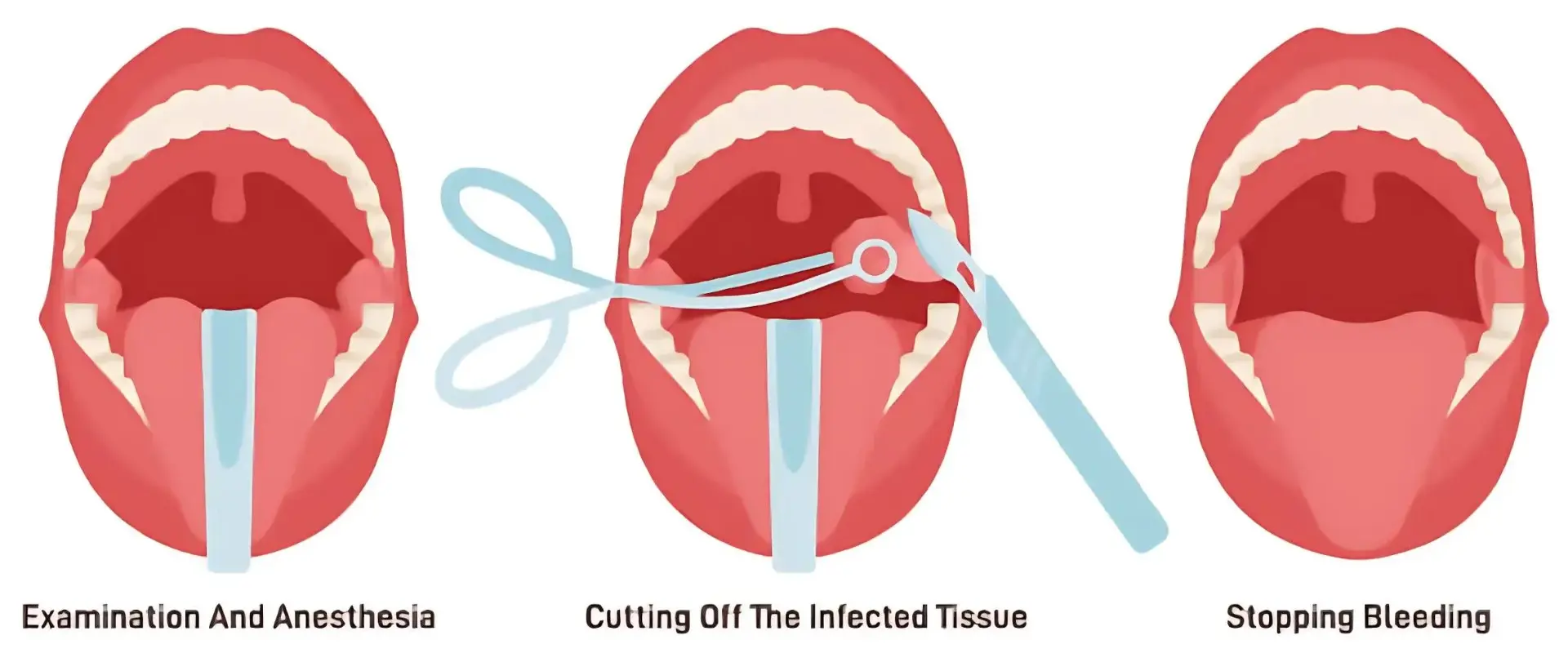 Tonsillectomy